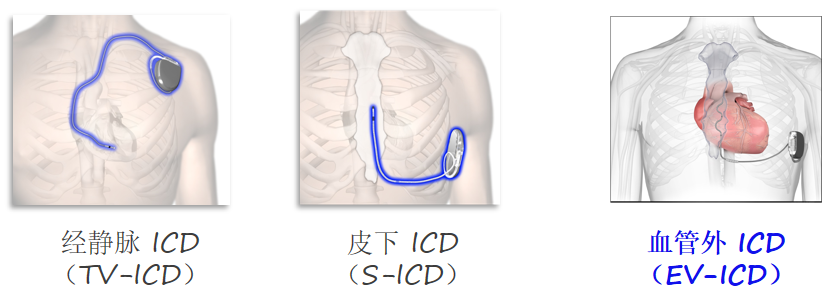 泰心医院完成首例EV-ICD植入 晕厥少年生命得到续航1.png 泰心医院完成首例EV-ICD植入 晕厥少年生命得到续航1.png